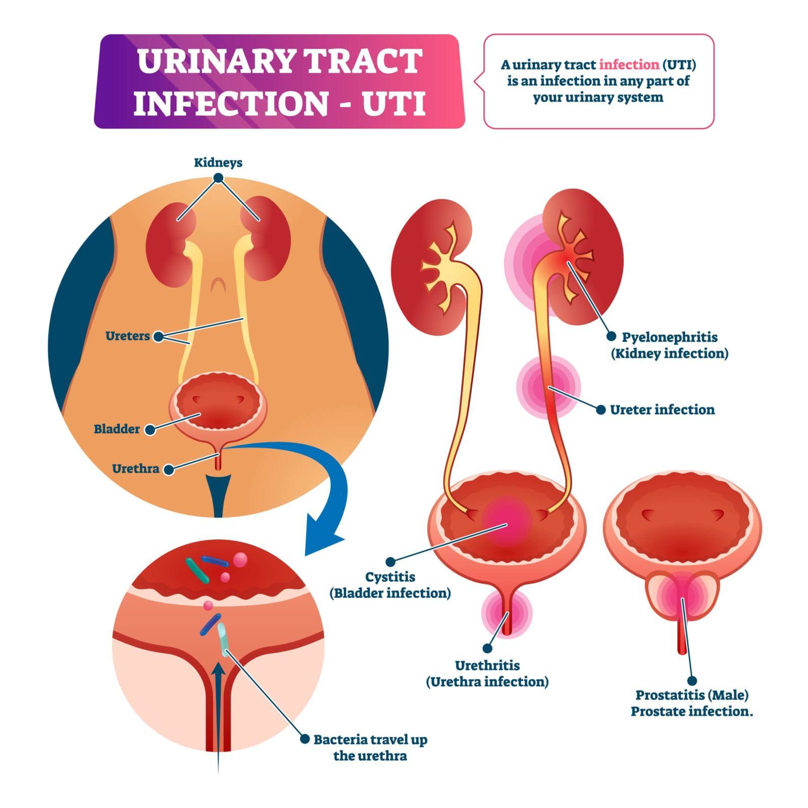 मूत्र पथ के संक्रमण (Urinary  Tract Infection)